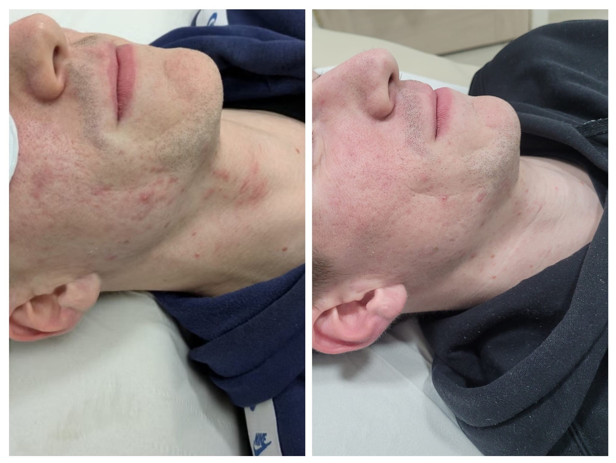 Microneedling: Small Needles, Powerful Skin Results