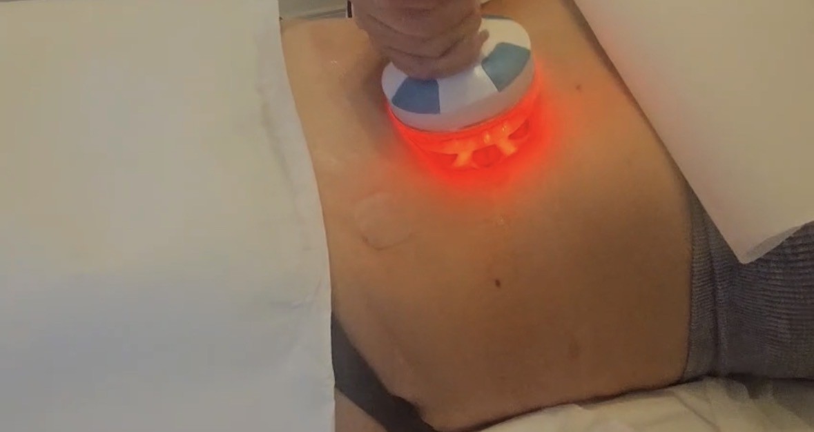 Refine, Sculpt, Define: A Smarter Approach to Body Contouring