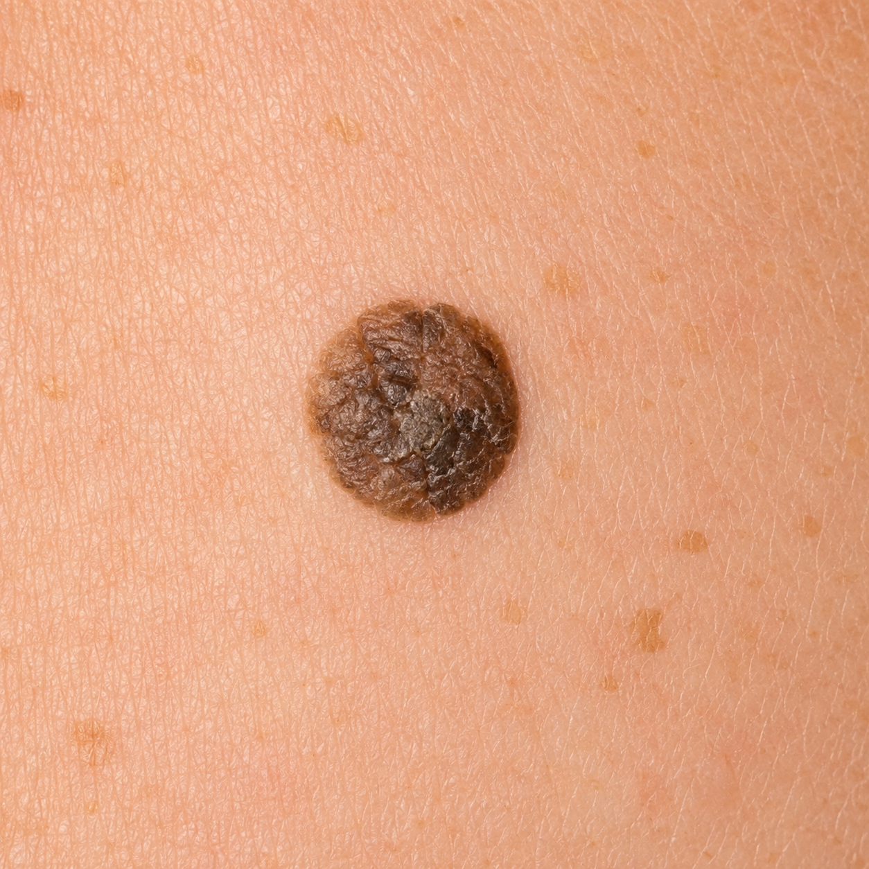 Seborrhoeic Keratosis