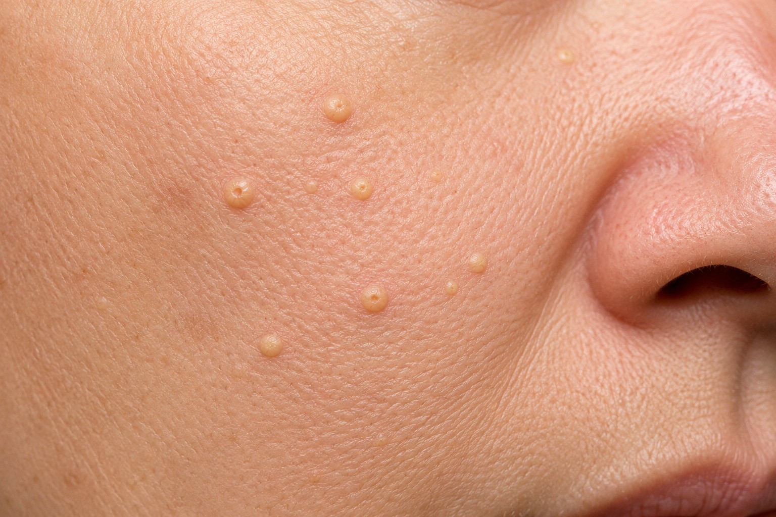 Sebaceous Hyperplasia 