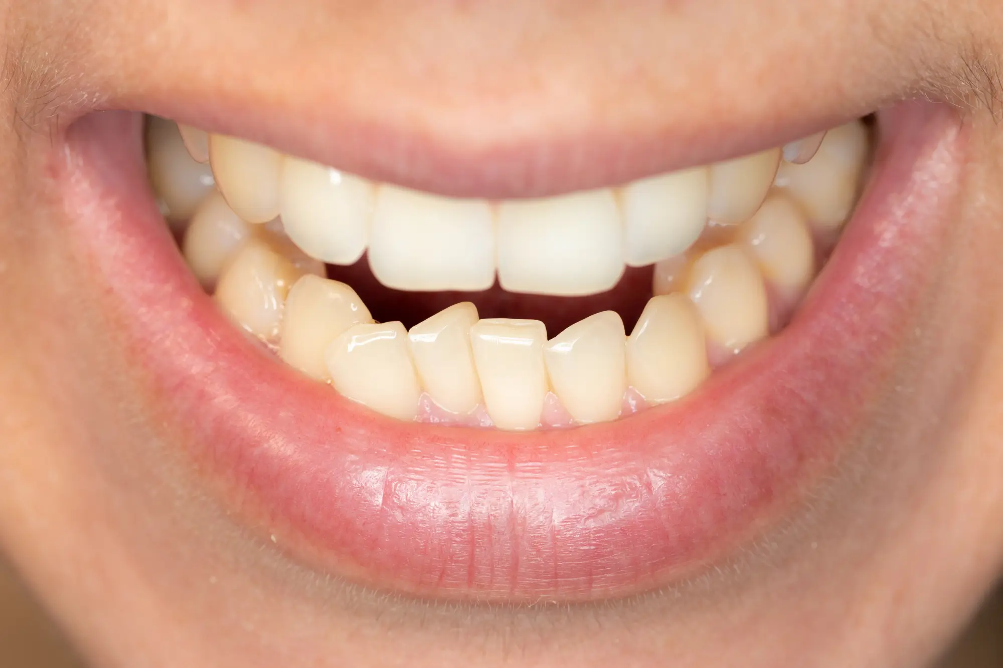 How Cosmetic Dentistry Fixes Cracked, Stained, or Uneven Teeth