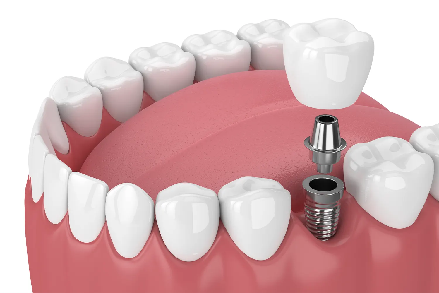 Pros and Cons of Dental Implants