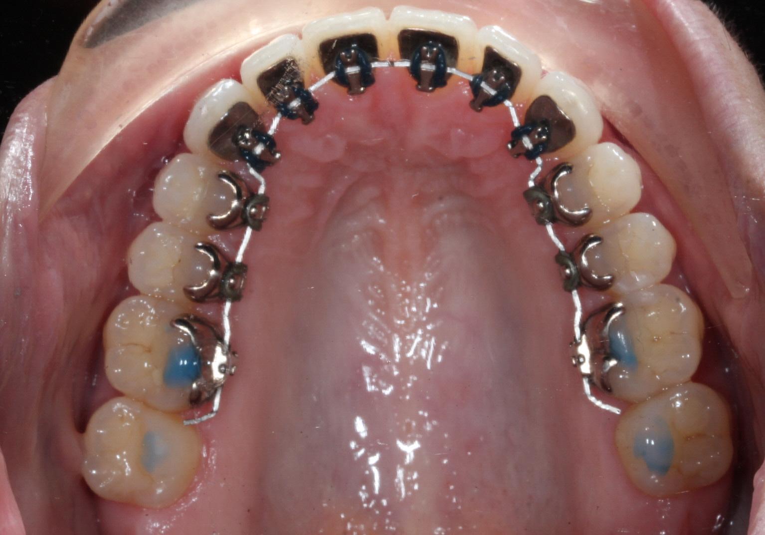 Lingual braces on Adult orthodontic patient with Nashville Orthodontist Dr. Craig Starling