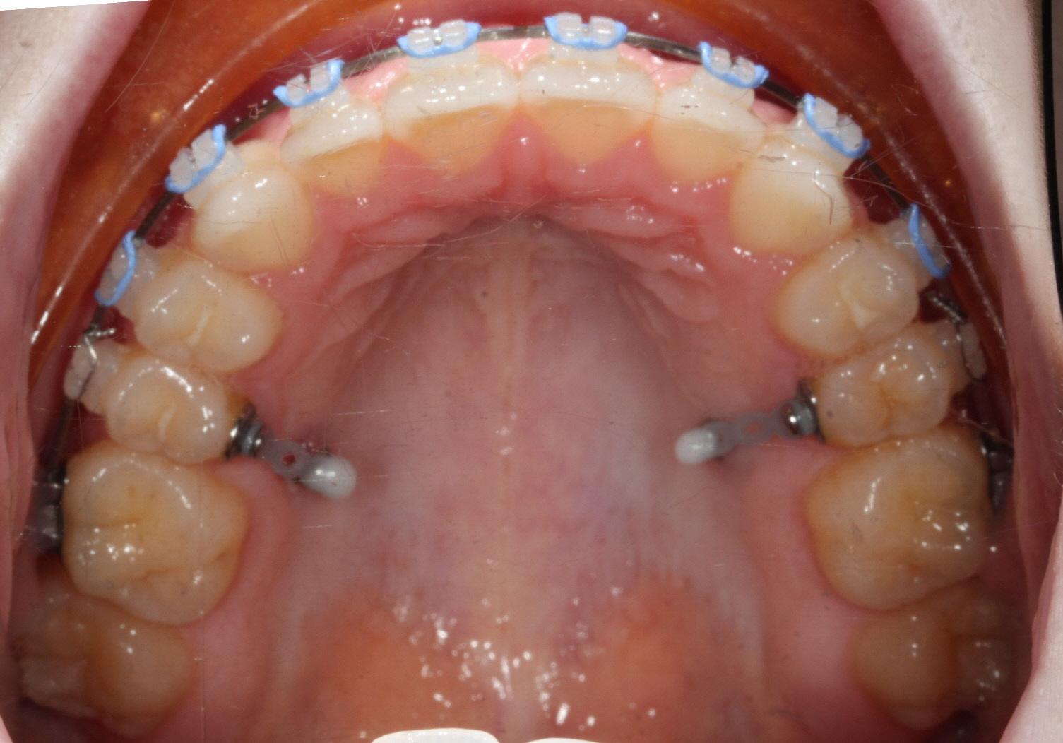 TADS for correction "over-erupted" teeth with Nashville Orthodontist Dr. Craig Starling, DDS
