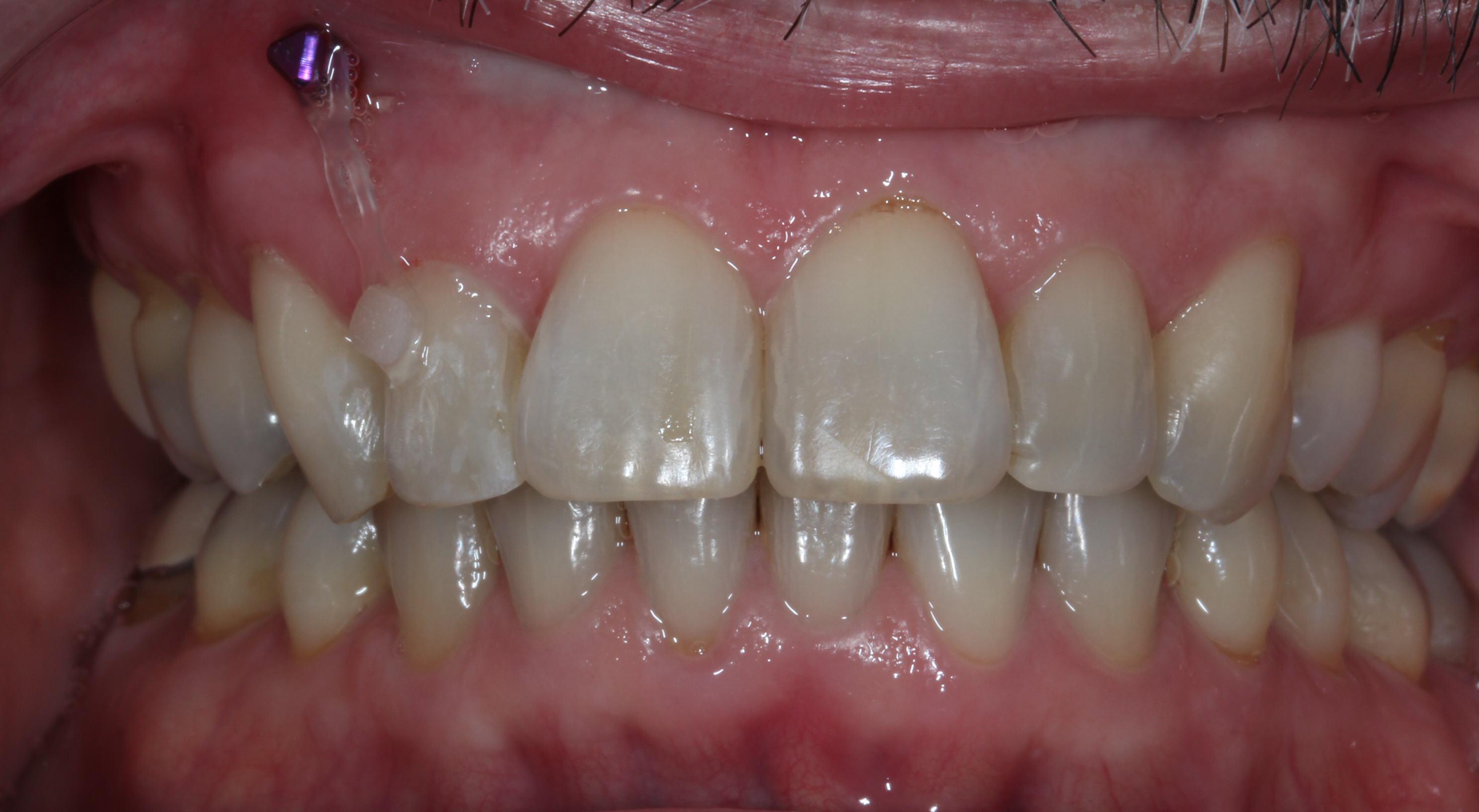 Temporary anchorage device (T.A.D.) used for a canted smile with Nashville Orthodontist Dr. Craig Starling
