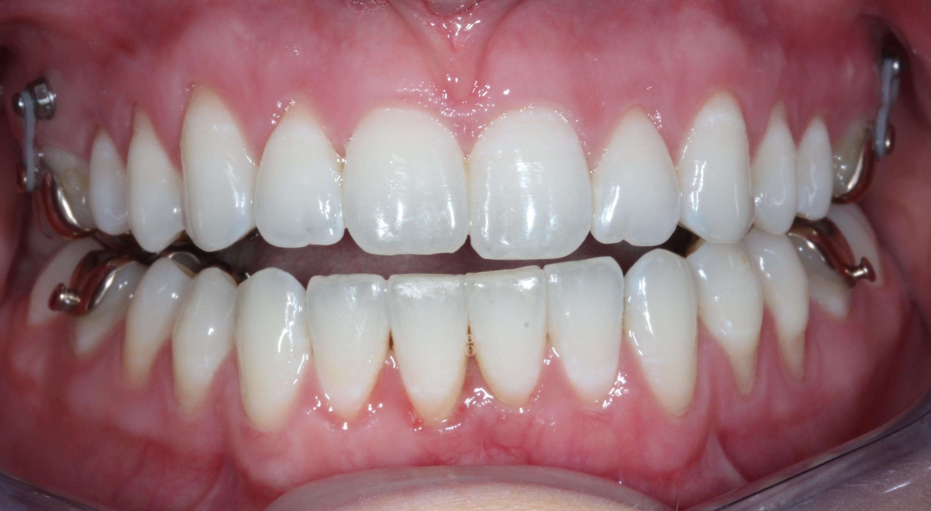 TADs for open bite correction with lingual braces Nashville Orthodontist Craig Starling, DDS