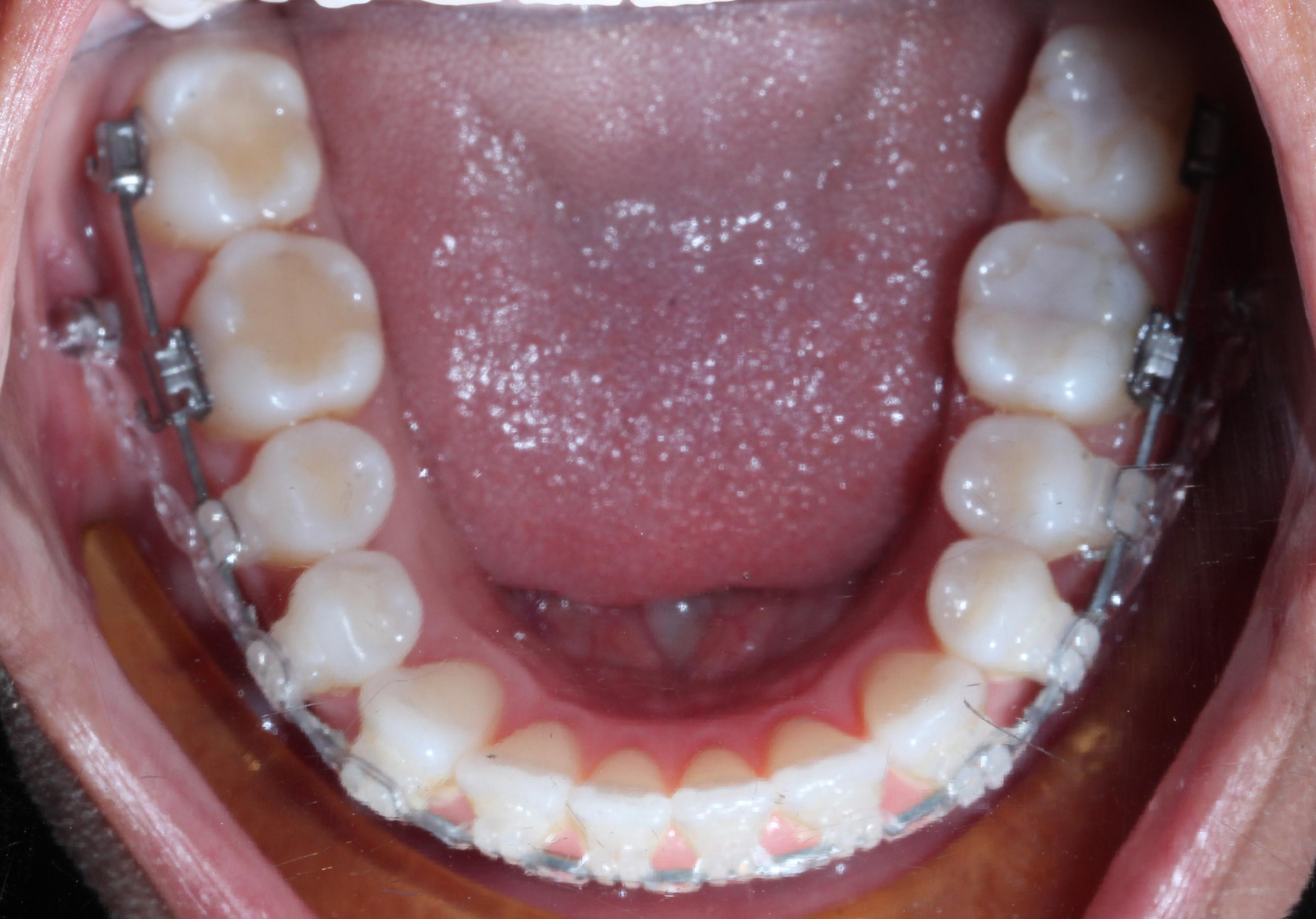 TADs used to correct an underbite with Nashville Orthodontist Dr. Craig Starling DDS at Starling Orthodontics