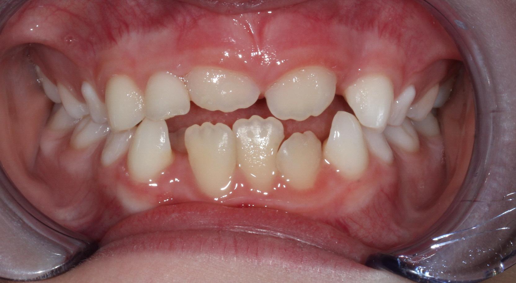 Seven year old bite showing heavy crowding and a crossbite at the Brentwood Orthodontic office of Starling Orthodontics.