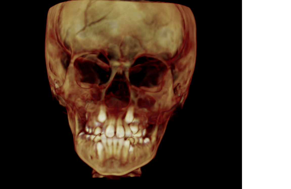 3D x-ray of developing dentition showing heavy dental crowding at Brentwood Orthodontist, Dr. Craig Starling