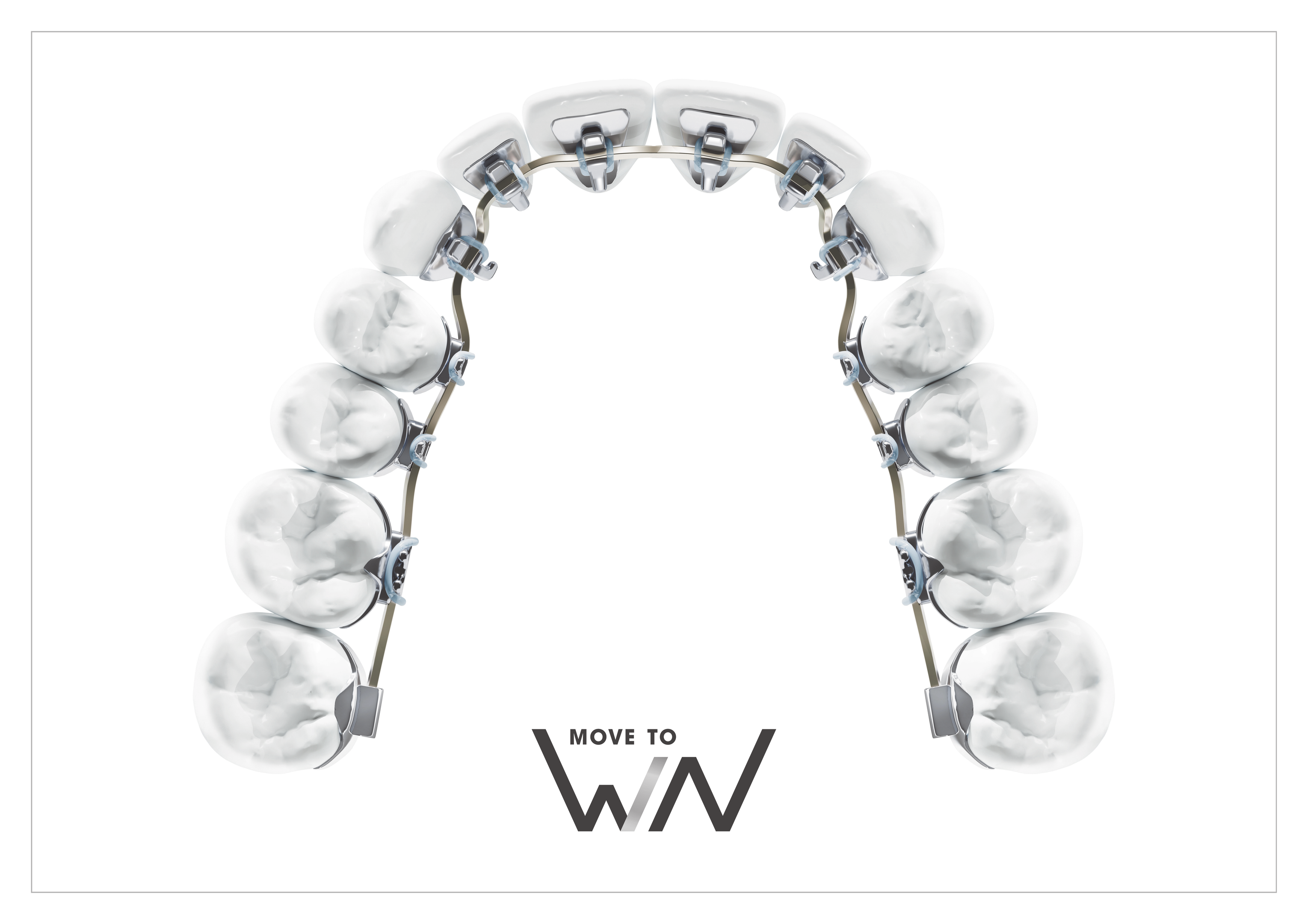 Lingual braces bonded to the back of teeth at Starling Orthodontics in Brentwood, TN, which are a completely hidden orthodontic treatment option