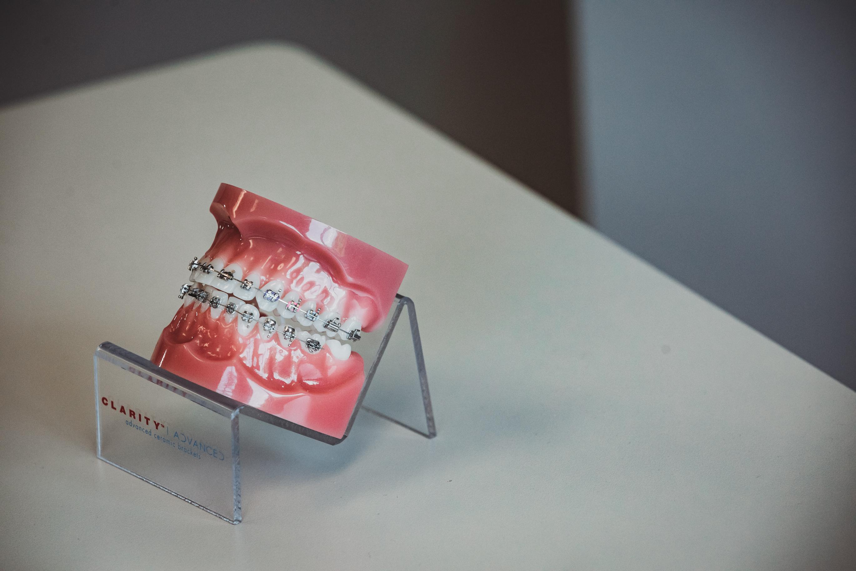 Metal braces dental model on display at Starling Orthodontics in Brentwood, TN teen braces treatment option