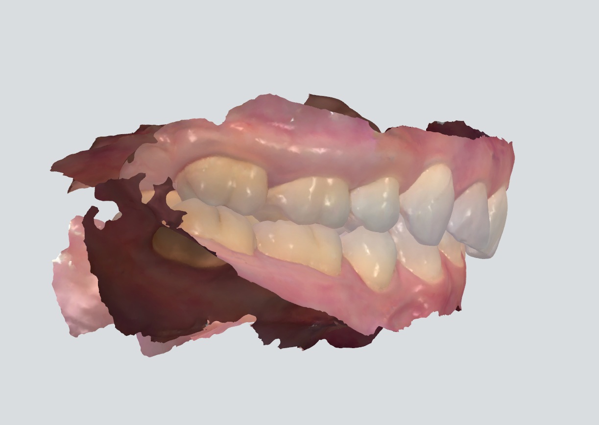 3D intraoral scan showing a deep overbite from the right side . The upper front teeth are significantly overlapping the lower teeth before lingual braces treatment at Starling Orthodontics in Nashville, TN