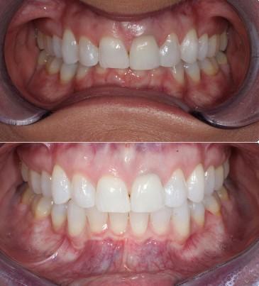Lingual braces overbite results at Nashville Orthodontist Starling Orthodontics