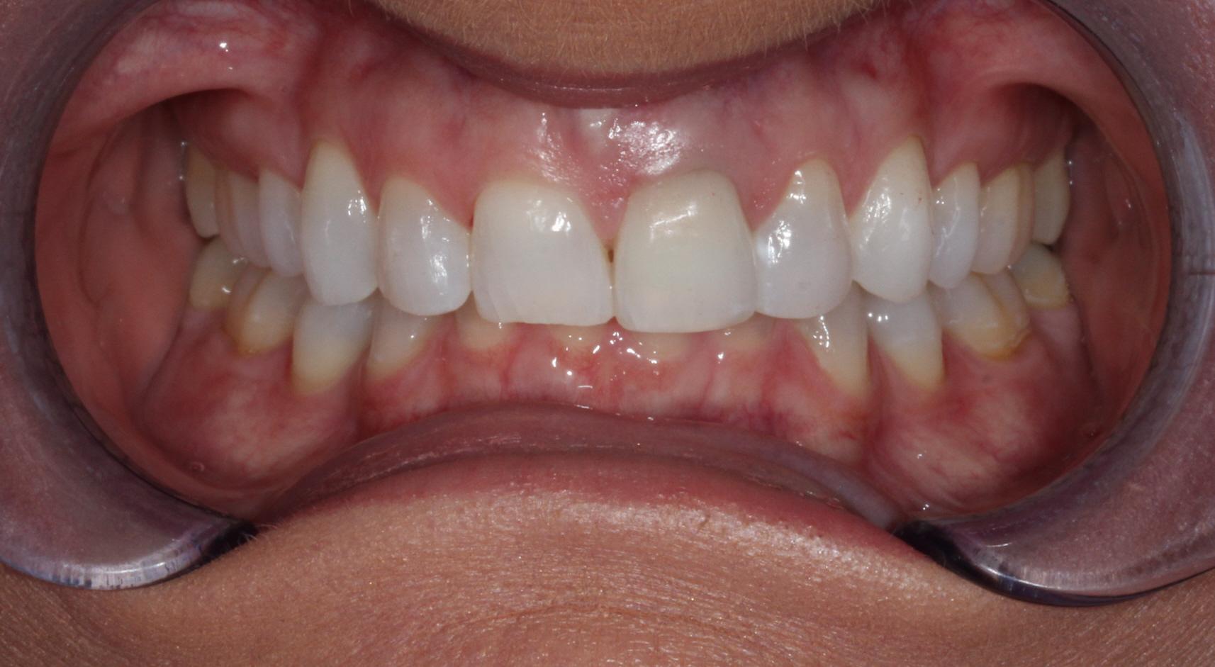 Patient deep overbite to be treated with lingual braces at Nashville Orthodontist Starling Orthodontics