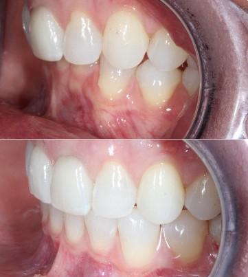 Overbite results with lingual braces at Nashville Orthodontist office Starling Orthodontics