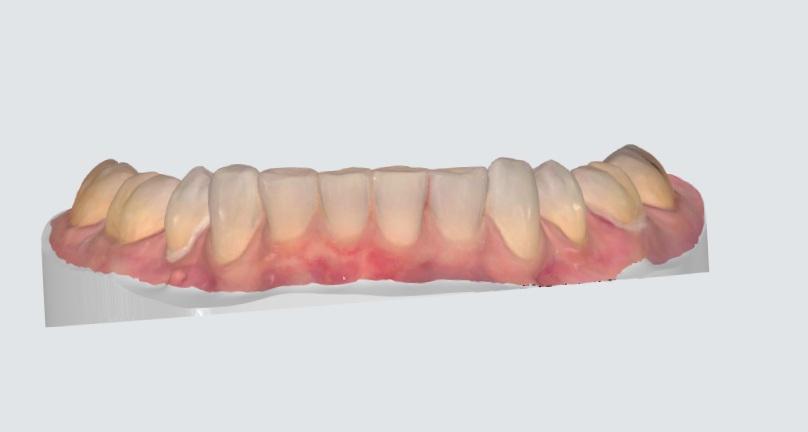 Digital scan after overbite was corrected with lingual braces at Starling Orthodontics Nashville, TN