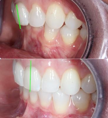 Green lines showing correction of "leaned back" upper teeth using lingual braces at Nashville Orthodontist office Starling Orthodontics