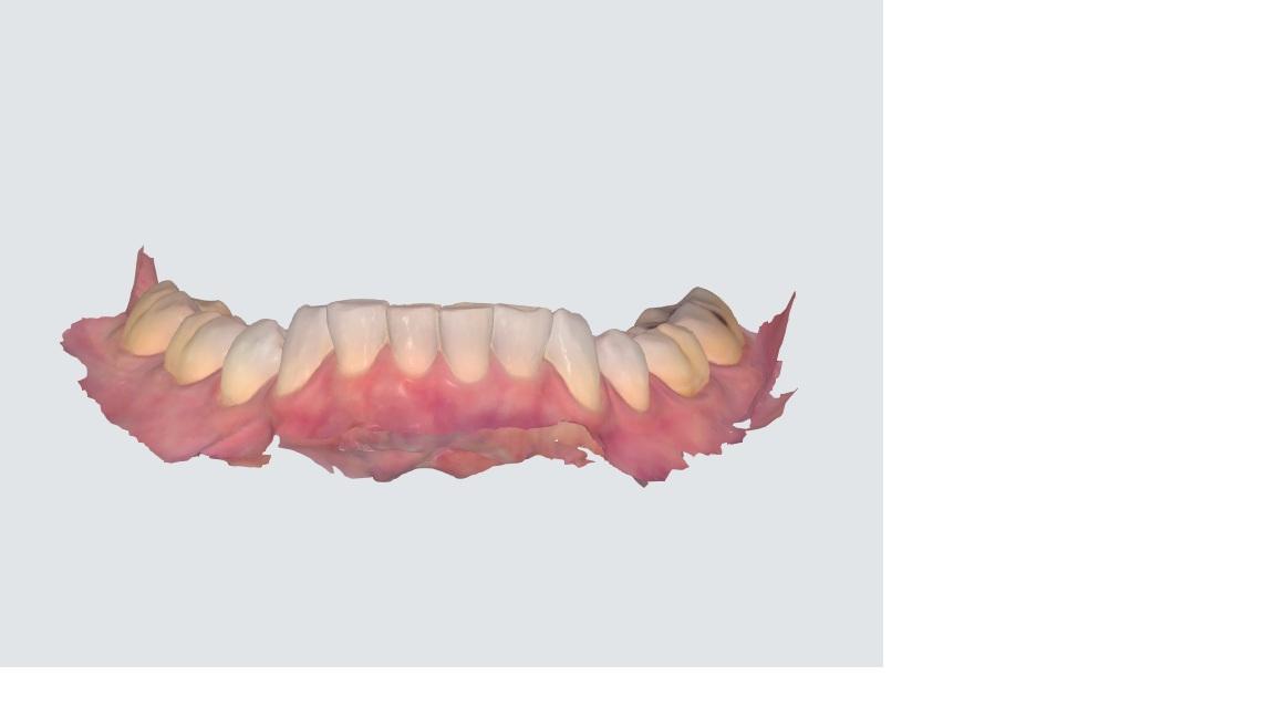 A digital scan on an Overbite patient showing lower front teeth higher than the back teeth