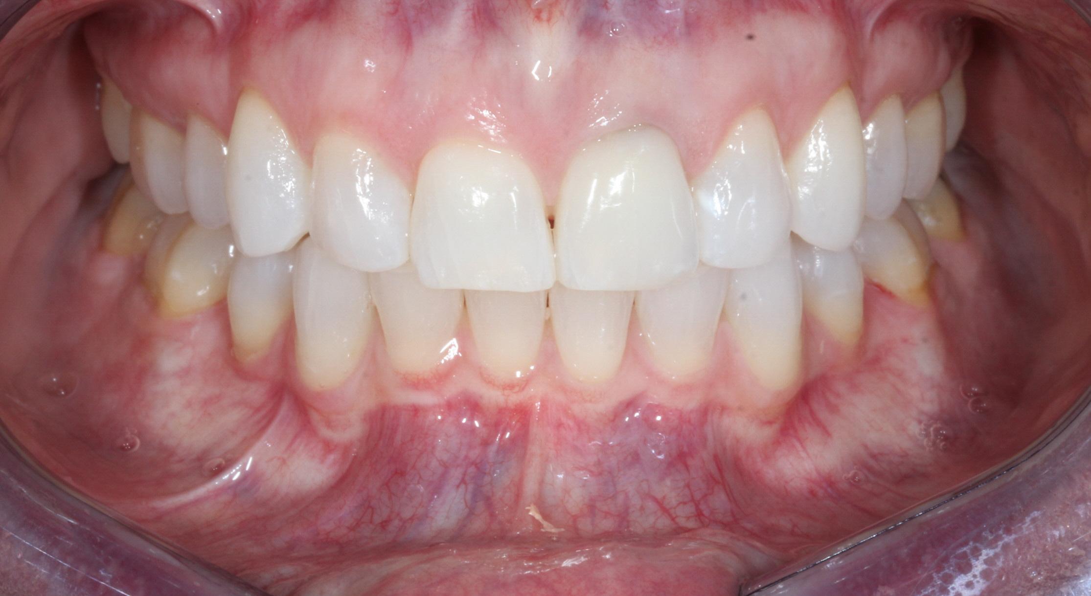Overbite correction with lingual braces at Starling Orthodontics in Nashville