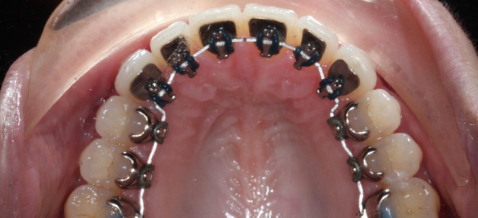 Incognito Lingual Braces attached behind the teeth for a discreet appearance at Starling Orthodontics Nashville TN