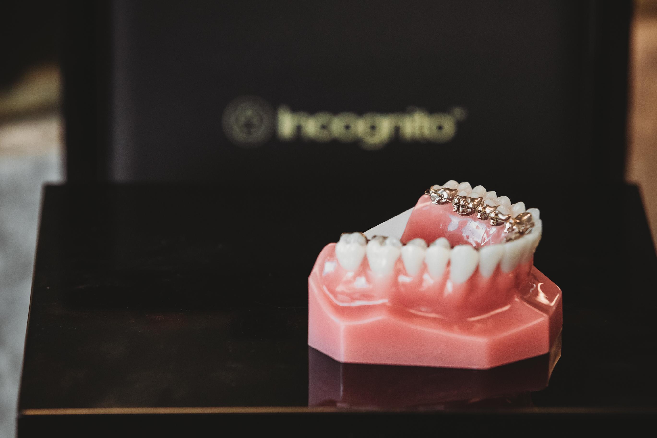 Incognito Lingual Braces at Starling Orthodontics discontinued in 2025
