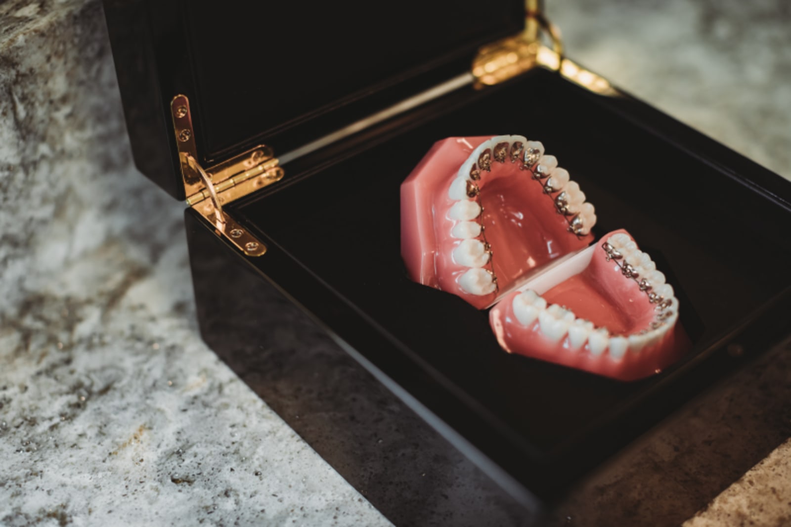 Lingual braces treatment at Starling Orthodontics in Brentwood, TN showing hidden orthodontic appliances behind teeth.