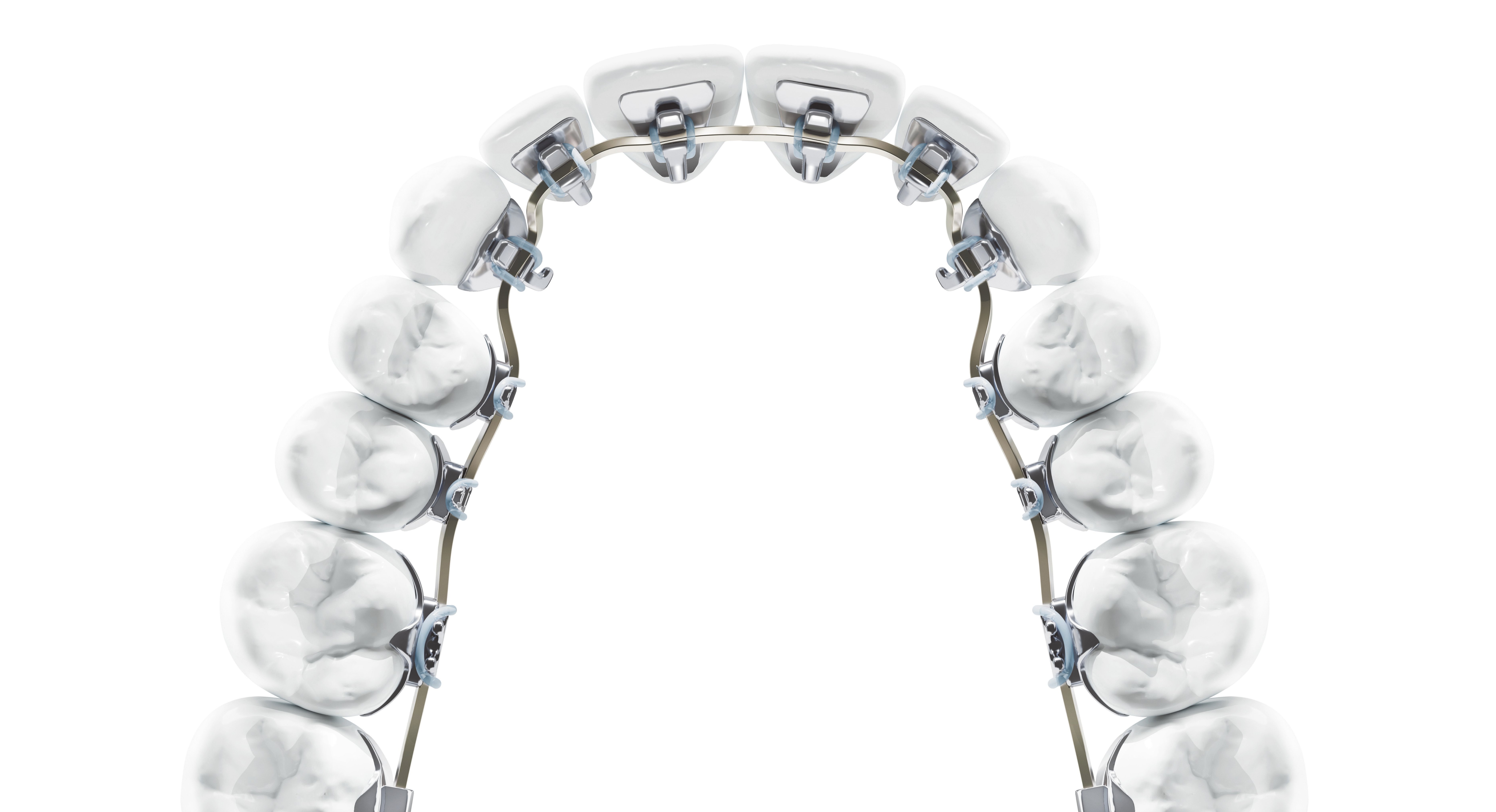 Behind the teeth braces in Nashville, TN at Starling Orthodontics