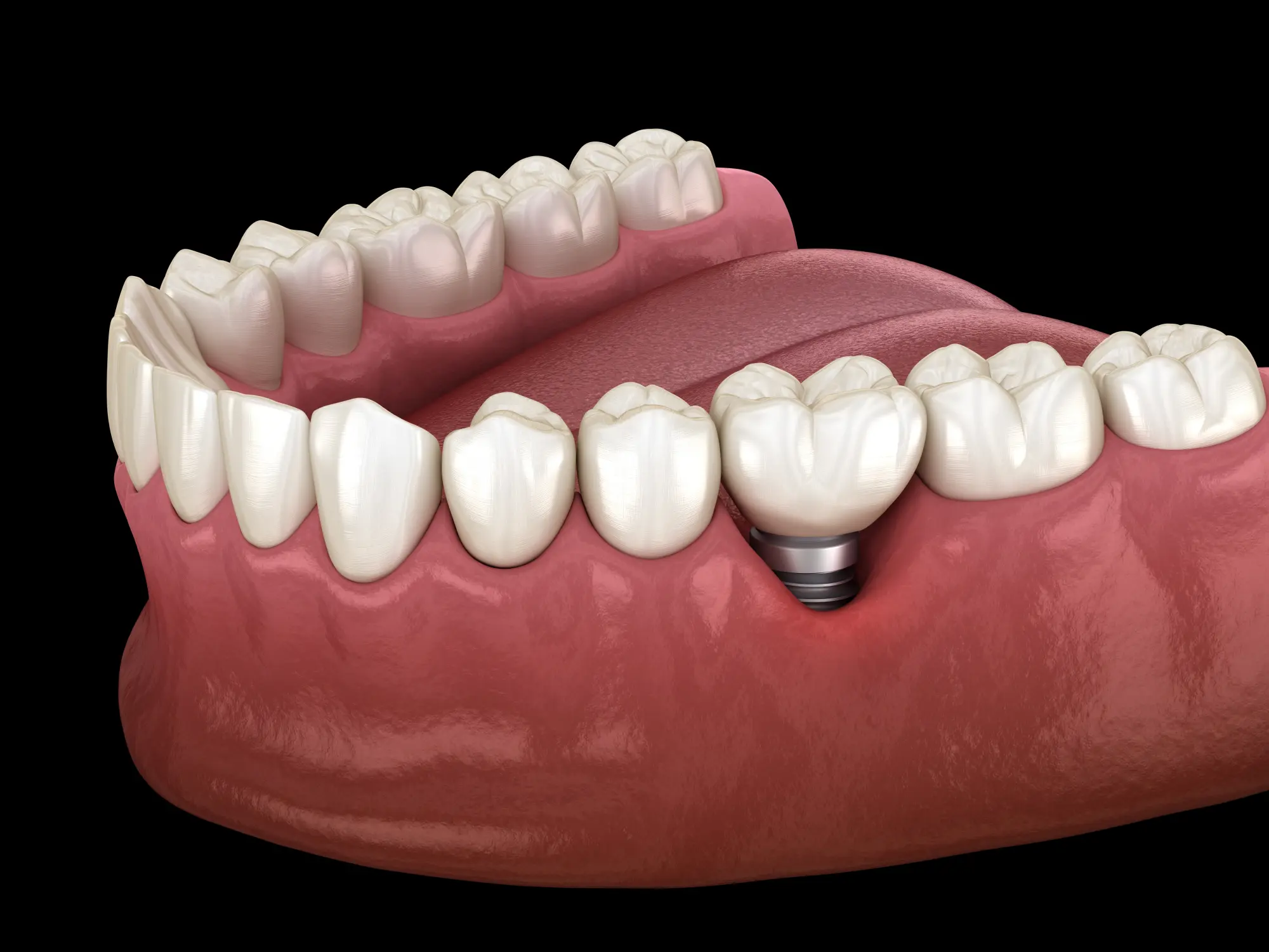 Is a Dental Bridge More Affordable Than a Dental Implant?