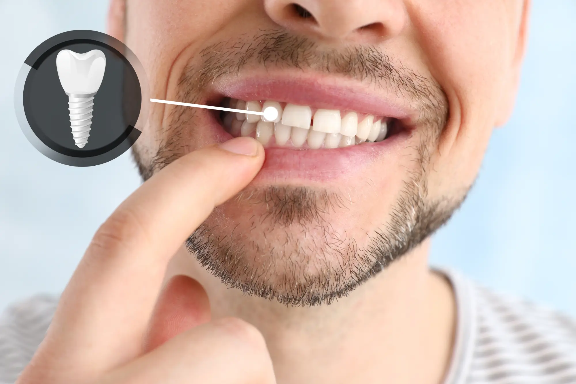 Dental Implants in Margate: Rebuilding the Foundation of Your Lifestyle