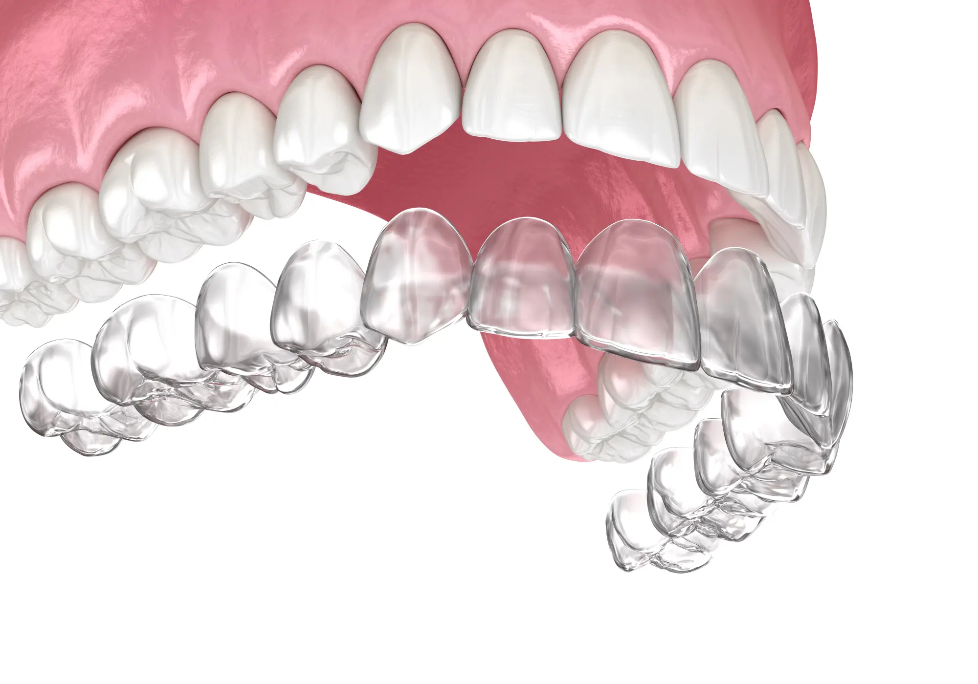 How to Clean Invisalign Trays: A Complete Care Guide