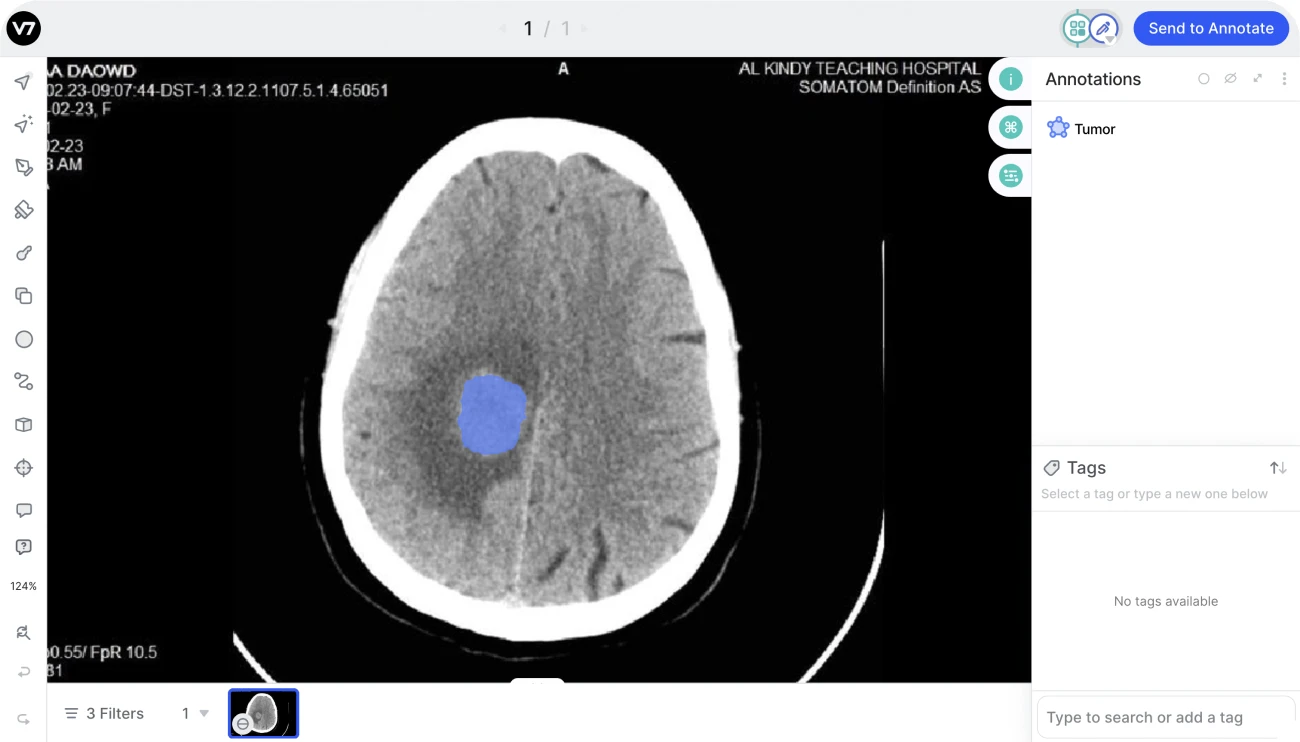 annotating brain tumor in v7