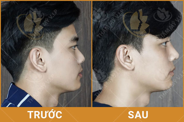 Tiêm Filler nâng mũi giá bao nhiêu