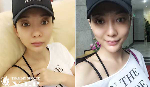 Tiêm Filler nâng mũi giá bao nhiêu