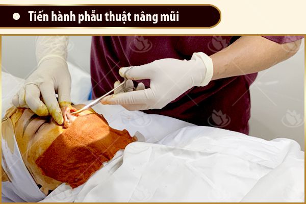 tiến hành thiết kế nâng mũi bán cấu trúc