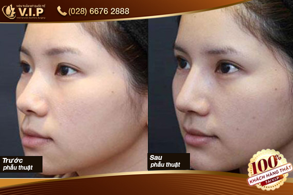 tiêm filler mũi có đau không