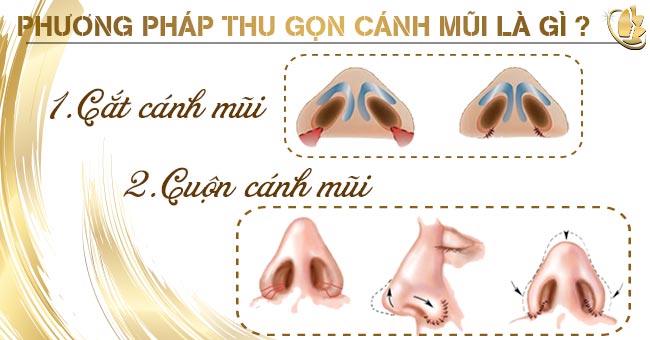 Cách phương pháp thu gọn cánh mũi