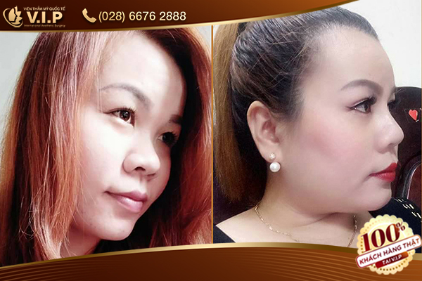 nâng mũi s line ở đâu đẹp