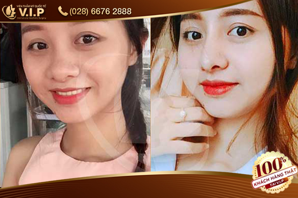 nâng mũi s line ở đâu đẹp