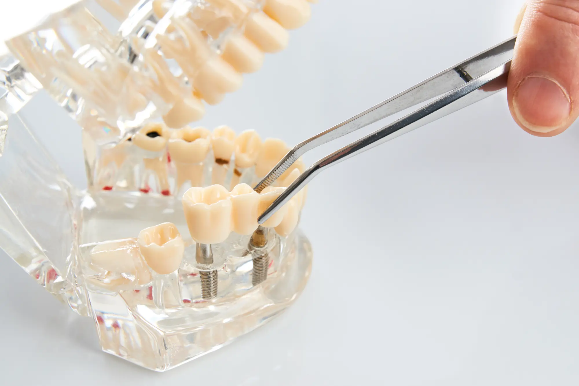 Exploring Different Materials for Dental Implants: Zirconia vs. Titanium