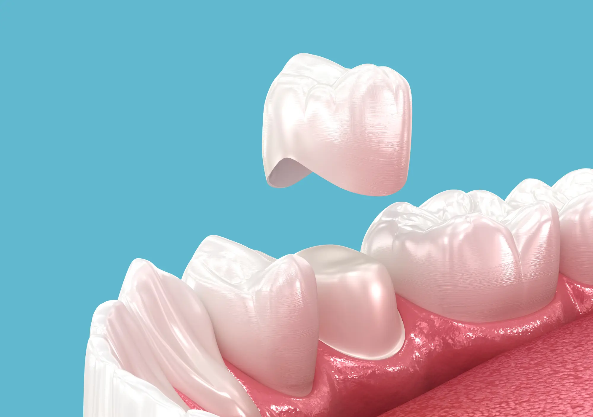 Is a Same-Day Dental Crown as Strong as a Traditional Lab Crown?