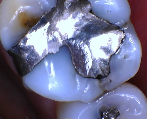 a woman patient in dental chair talking to woman hygienist