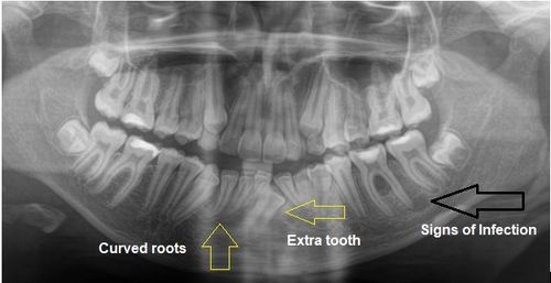 dental hygienist checking out a male patient's teeth