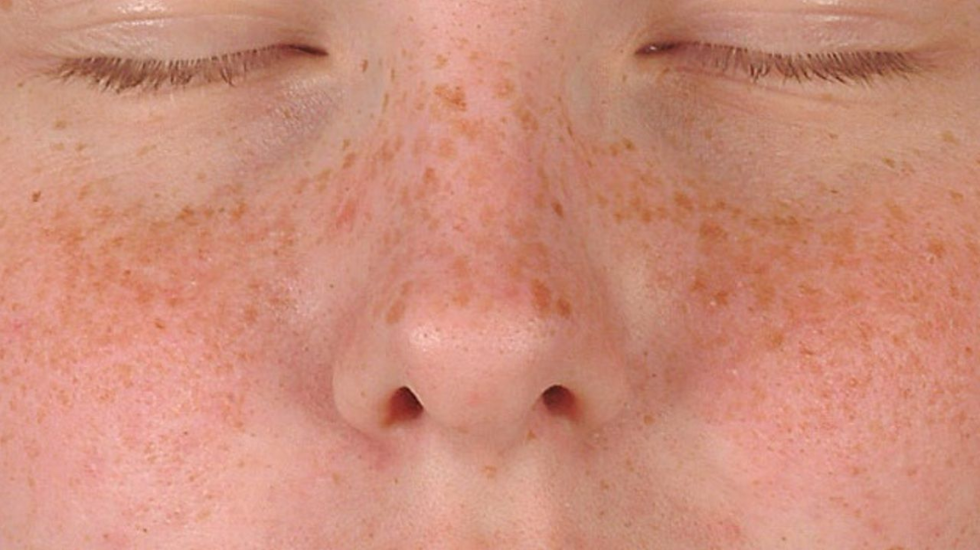Close-up of a person’s face showing sun-induced freckles, known as ephelides, across the nose and cheeks.