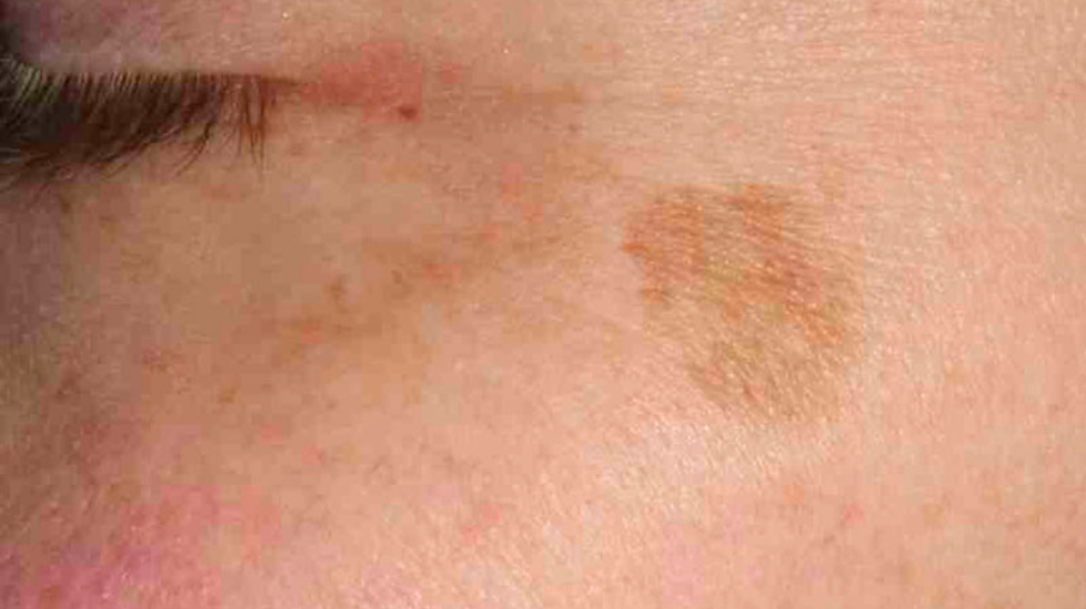 This image shows a solar lentigo, a common result of chronic sun exposure.