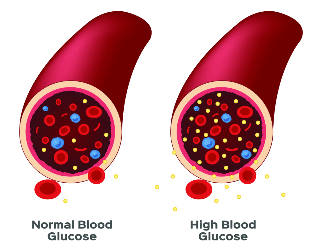 Normal vs. High Blood Glucose