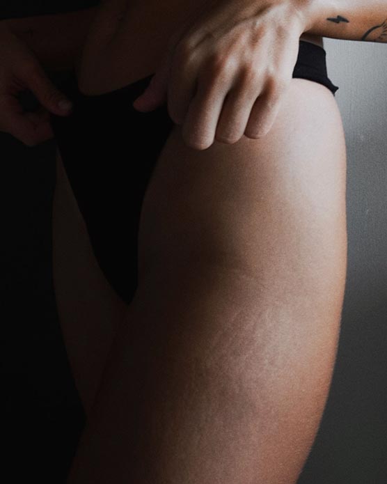 Bailey Rushlow shows off stretch marks on her thighs, embracing body confidence and self-acceptance