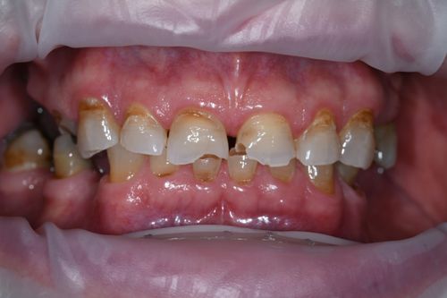 before and after treatment