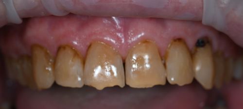 before and after treatment