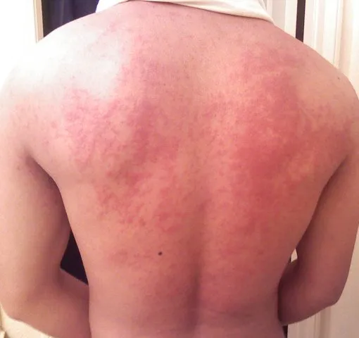 Hives on back