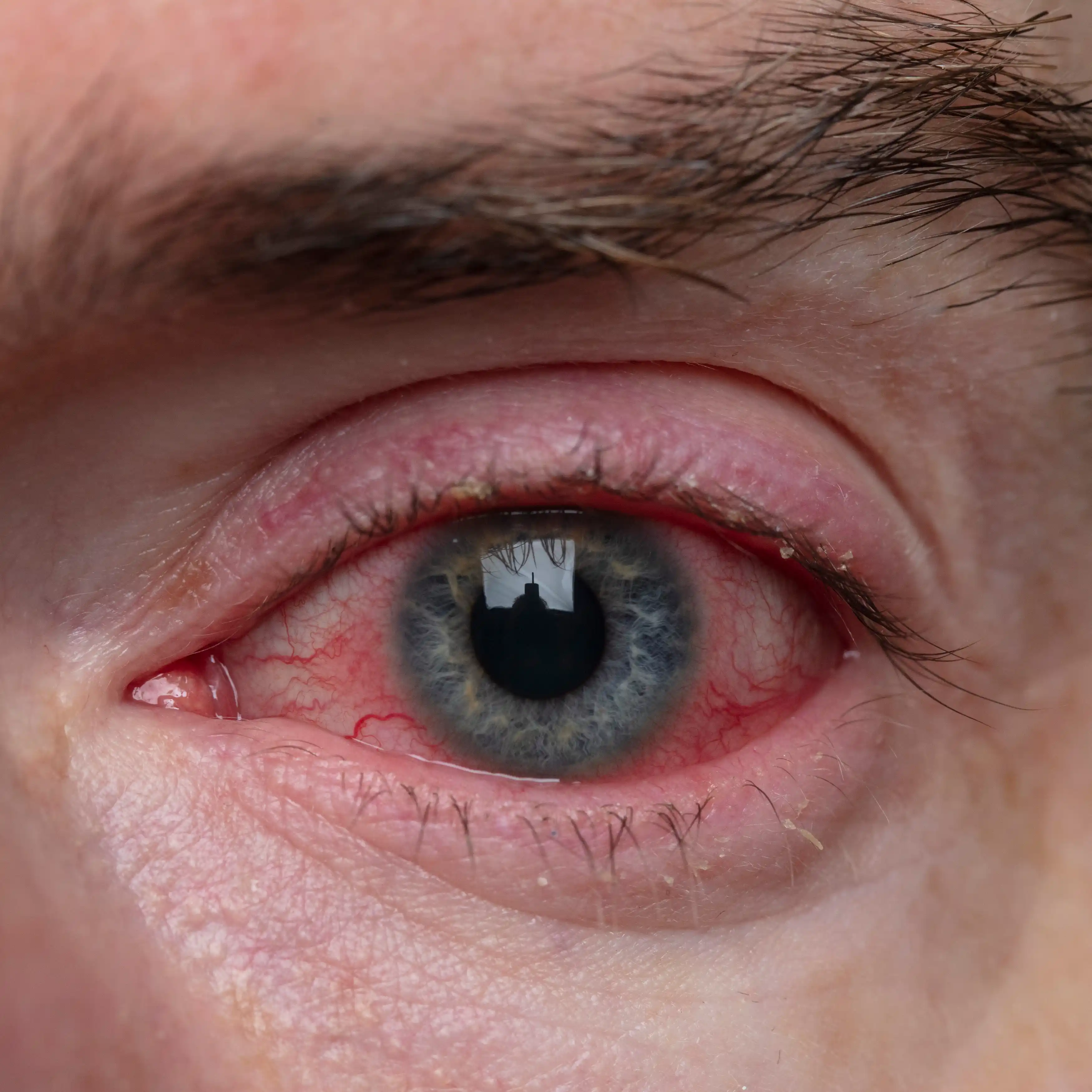 Close-up of a severely bloodshot eye, showing visible irritation and redness. The image reflects the intense physical effects of crack cocaine use, such as eye strain and burst blood vessels, which are common among individuals entering crack addiction recovery programs.